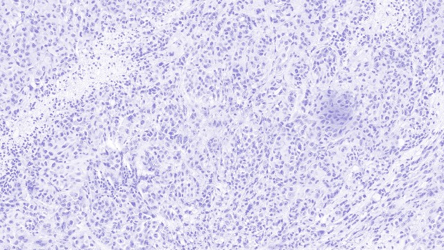 Image representing the publication, Association of Melanoma-Risk Variants with Primary Melanoma Tumor Prognostic Characteristics and Melanoma-Specific Survival in the GEM Study